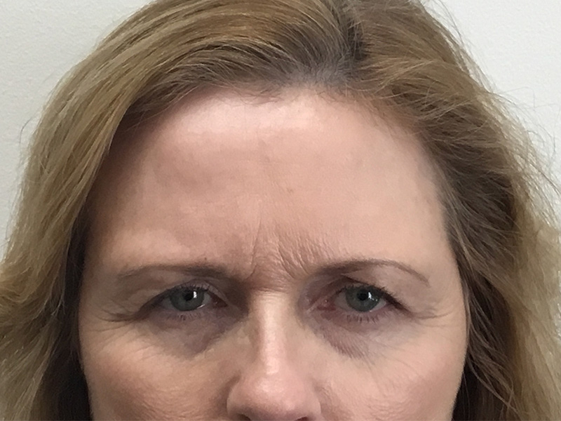Brow Lift And Blepharoplasty Before and After | Montilla Plastic Surgery 