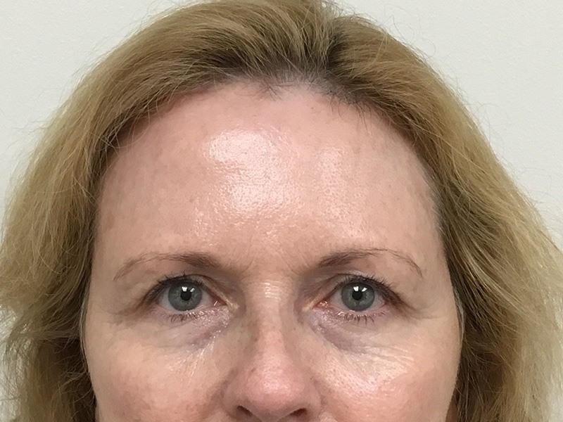 Brow Lift And Blepharoplasty Before and After | Montilla Plastic Surgery 