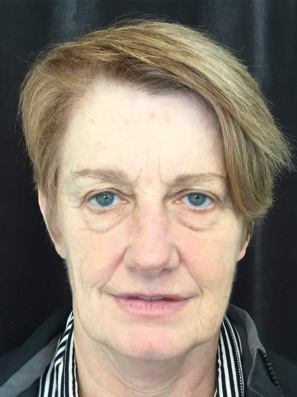 Brow Lift And Blepharoplasty Before and After | Montilla Plastic Surgery 