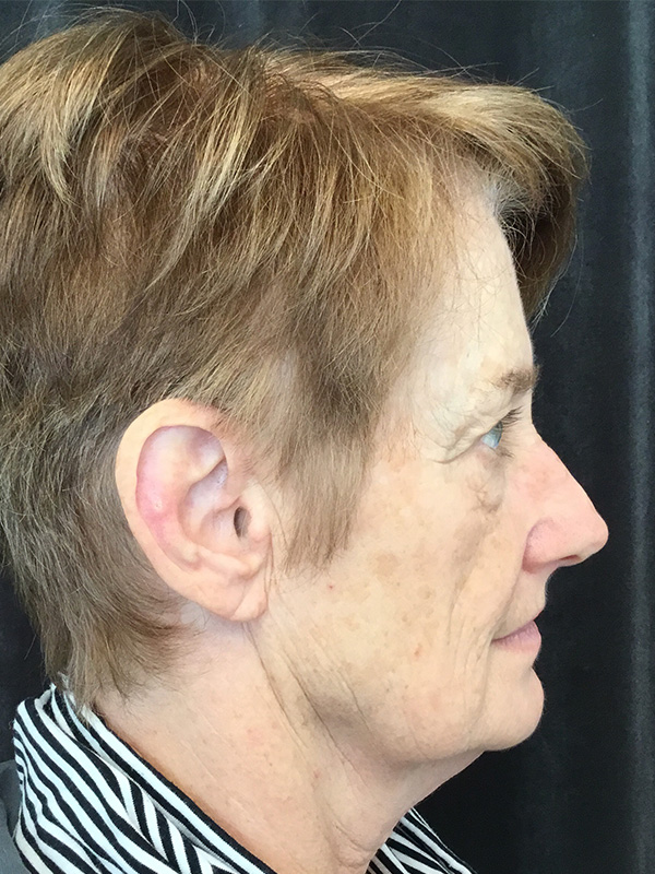 Brow Lift And Blepharoplasty Before and After | Montilla Plastic Surgery