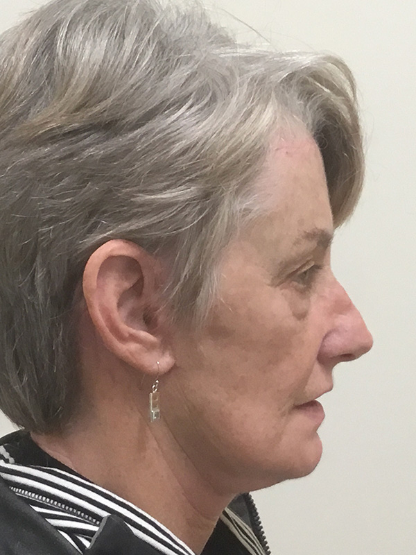 Brow Lift And Blepharoplasty Before and After | Montilla Plastic Surgery