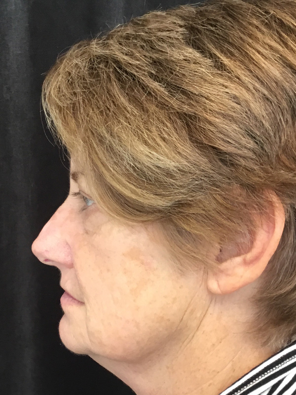 Brow Lift And Blepharoplasty Before and After | Montilla Plastic Surgery