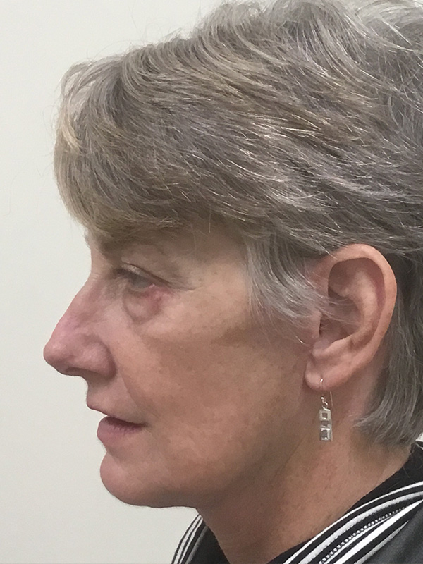 Brow Lift And Blepharoplasty Before and After | Montilla Plastic Surgery