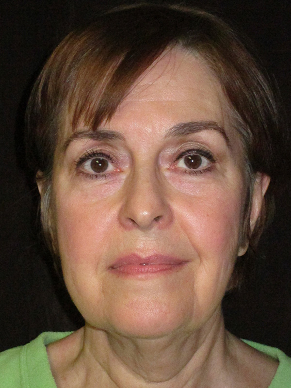 Brow Lift And Blepharoplasty Before and After | Montilla Plastic Surgery 