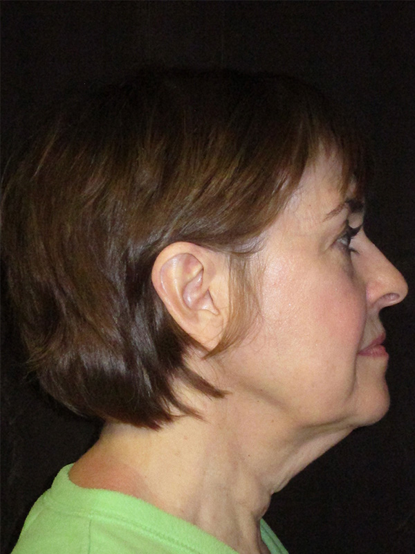 Brow Lift And Blepharoplasty Before and After | Montilla Plastic Surgery