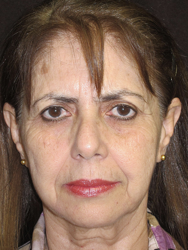 Brow Lift And Blepharoplasty Before and After | Montilla Plastic Surgery 
