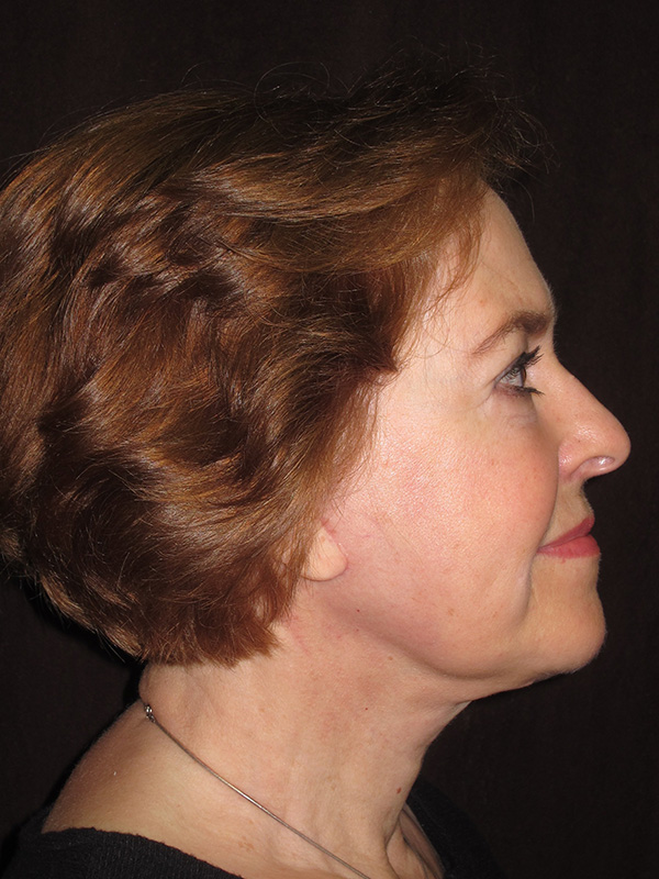 Brow Lift And Blepharoplasty Before and After | Montilla Plastic Surgery