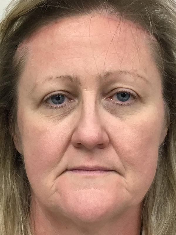 Brow Lift And Blepharoplasty Before and After | Montilla Plastic Surgery 