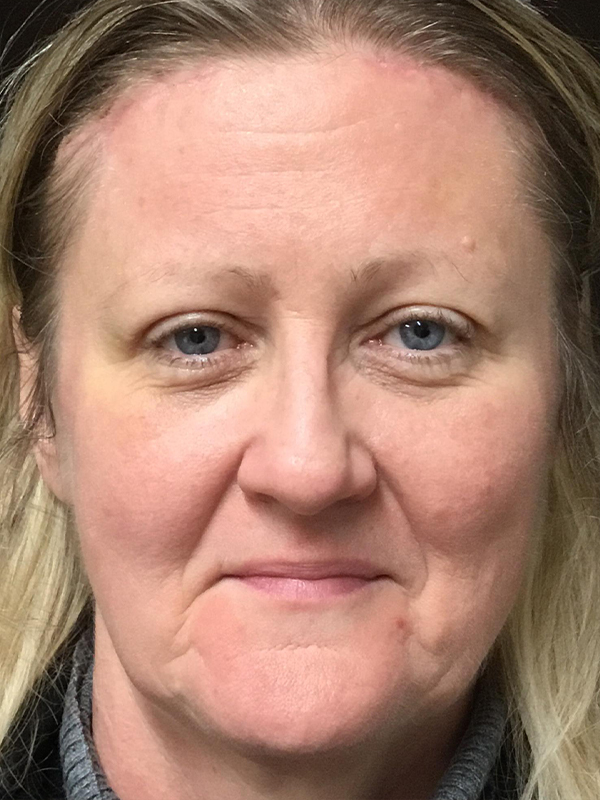 Brow Lift And Blepharoplasty Before and After | Montilla Plastic Surgery 