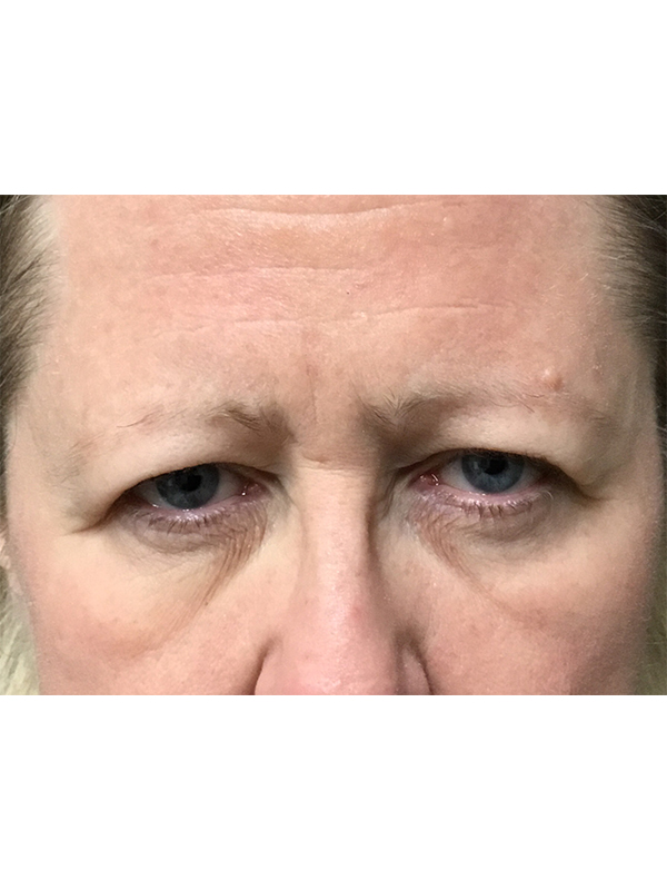 Brow Lift And Blepharoplasty Before and After | Montilla Plastic Surgery