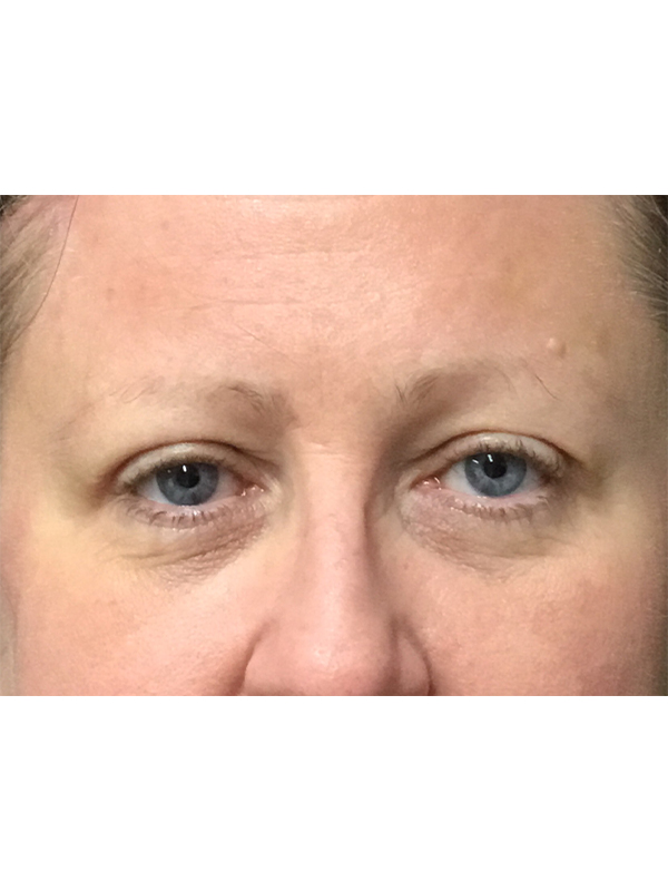 Brow Lift And Blepharoplasty Before and After | Montilla Plastic Surgery