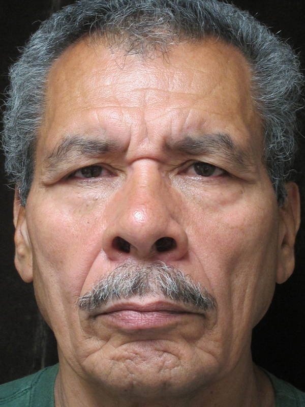 Brow Lift And Blepharoplasty Before and After | Montilla Plastic Surgery 