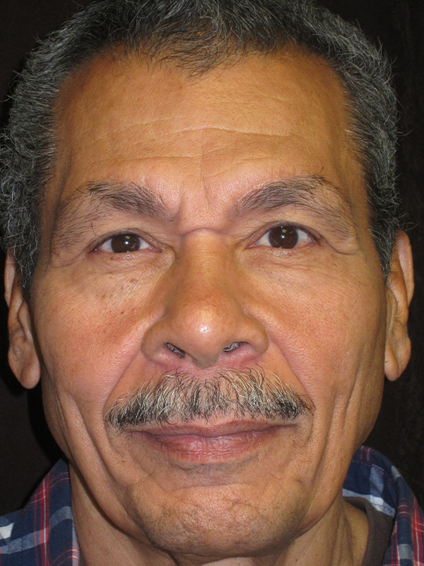 Brow Lift And Blepharoplasty Before and After | Montilla Plastic Surgery 