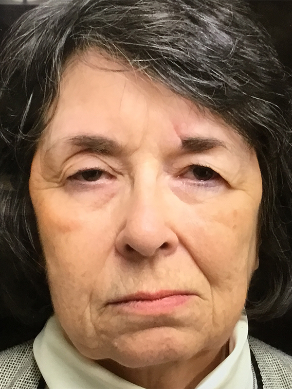 Brow Lift And Blepharoplasty Before and After | Montilla Plastic Surgery 