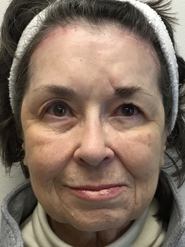 Brow Lift And Blepharoplasty Before and After | Montilla Plastic Surgery 
