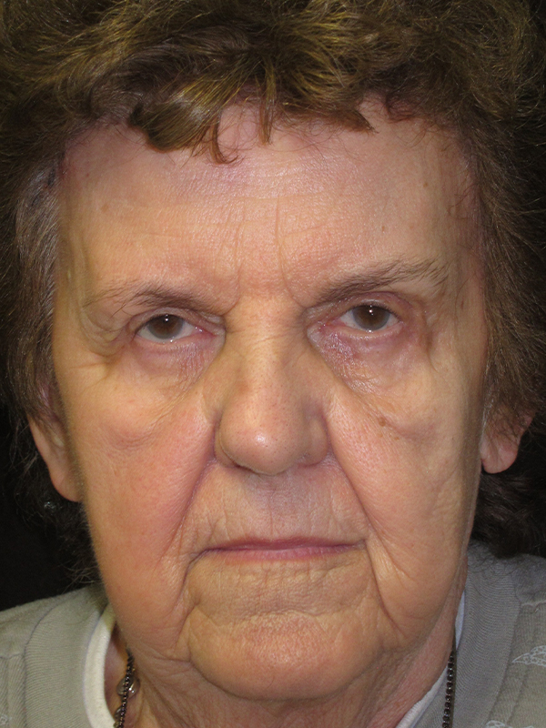 Brow Lift And Blepharoplasty Before and After | Montilla Plastic Surgery 