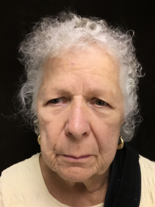 Brow Lift And Blepharoplasty Before and After | Montilla Plastic Surgery 