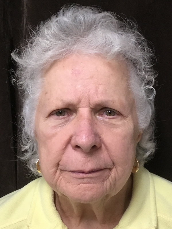 Brow Lift And Blepharoplasty Before and After | Montilla Plastic Surgery 