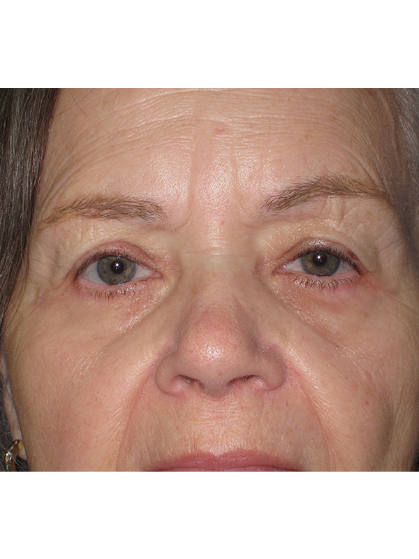 Brow Lift And Blepharoplasty Before and After | Montilla Plastic Surgery 