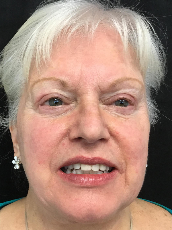Brow Lift And Blepharoplasty Before and After | Montilla Plastic Surgery 