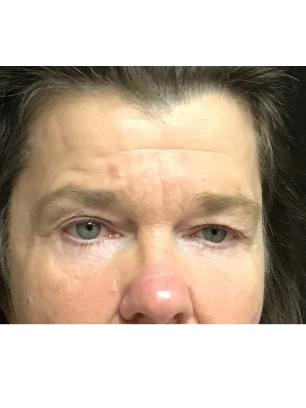 Brow Lift And Blepharoplasty Before and After | Montilla Plastic Surgery 
