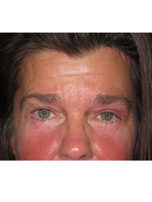 Brow Lift And Blepharoplasty Before and After | Montilla Plastic Surgery 
