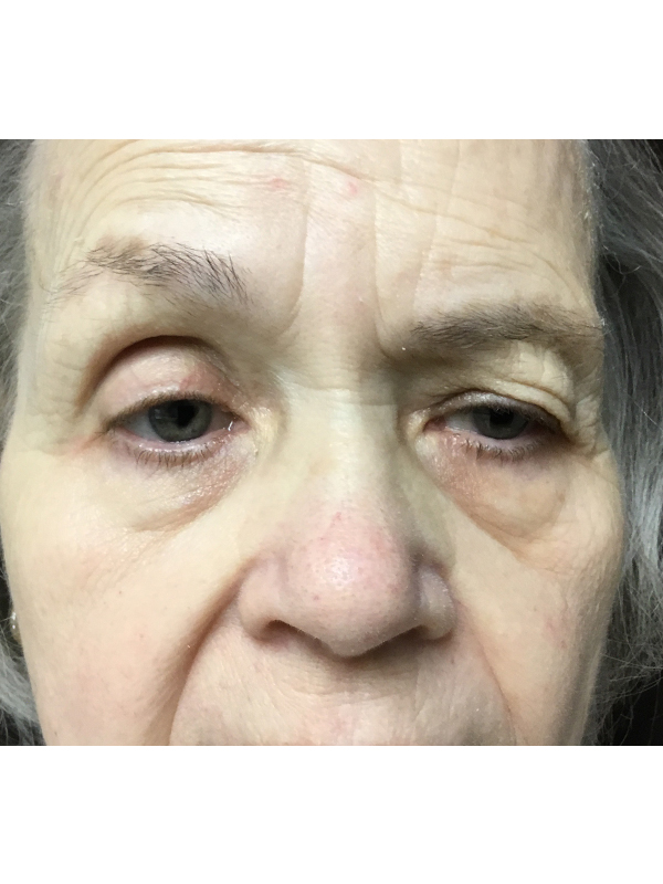 Brow Lift And Blepharoplasty Before and After | Montilla Plastic Surgery 