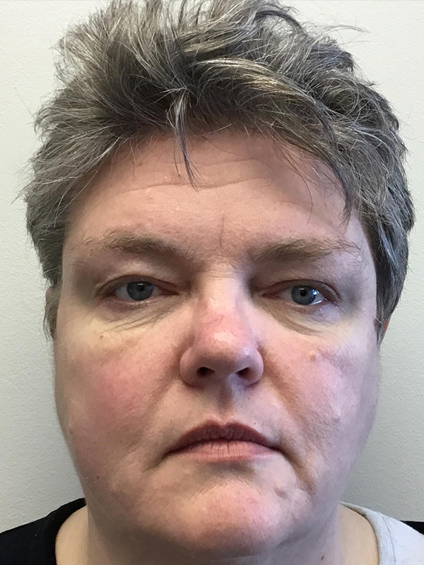 Brow Lift And Blepharoplasty Before and After | Montilla Plastic Surgery 