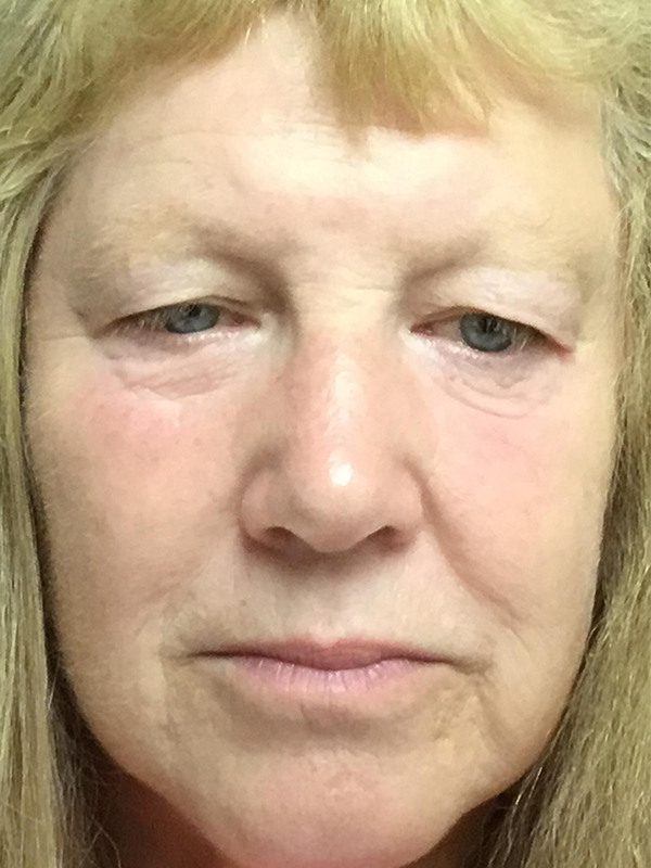 Brow Lift And Blepharoplasty Before and After | Montilla Plastic Surgery 