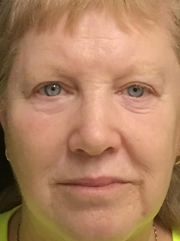 Brow Lift And Blepharoplasty Before and After | Montilla Plastic Surgery 