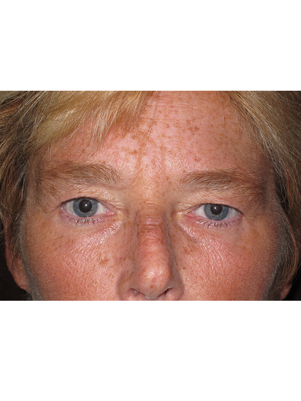 Brow Lift And Blepharoplasty Before and After | Montilla Plastic Surgery 