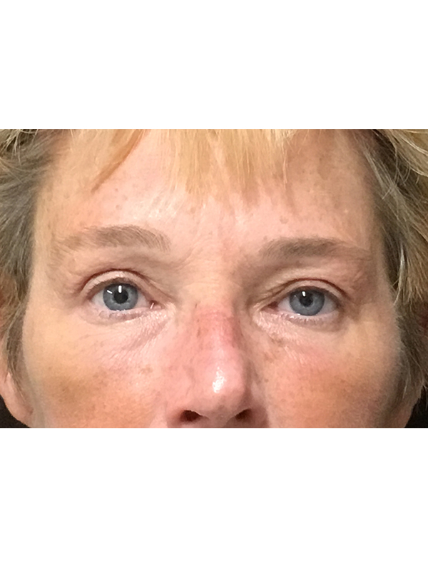 Brow Lift And Blepharoplasty Before and After | Montilla Plastic Surgery 