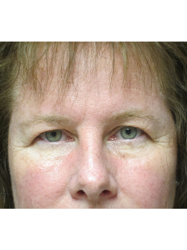 Brow Lift And Blepharoplasty Before and After | Montilla Plastic Surgery 