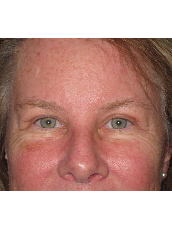 Brow Lift And Blepharoplasty Before and After | Montilla Plastic Surgery 