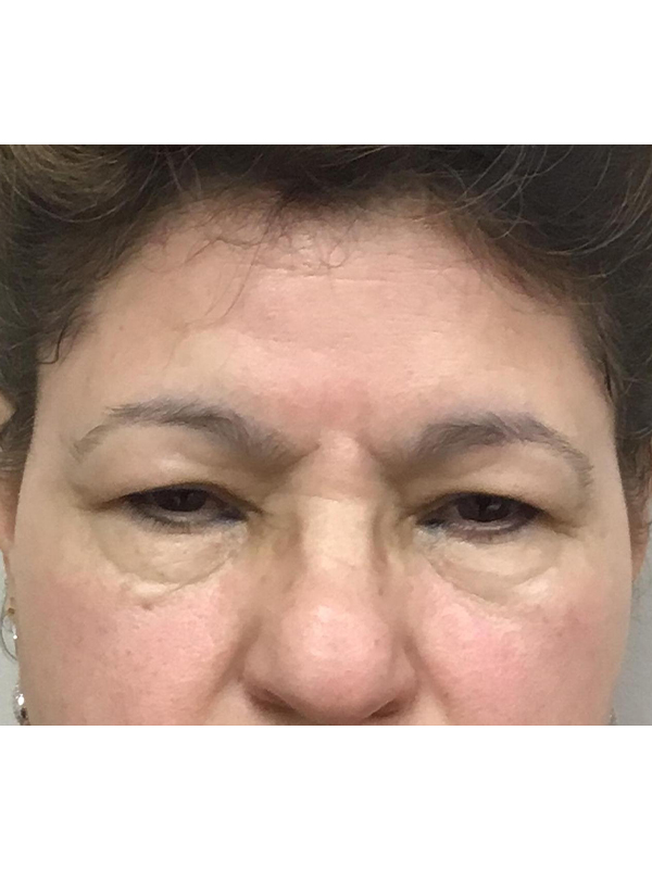 Brow Lift And Blepharoplasty Before and After | Montilla Plastic Surgery 