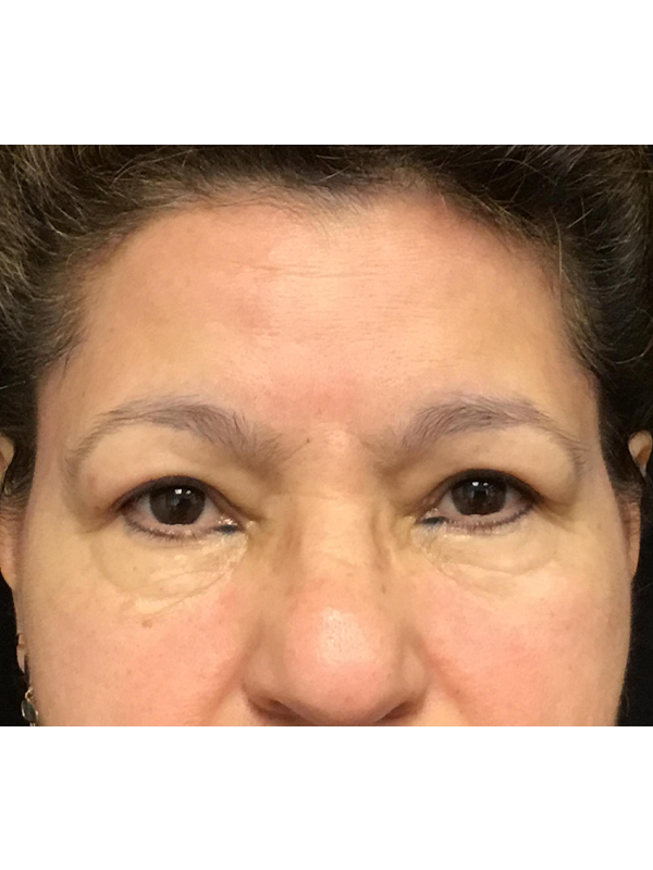 Brow Lift And Blepharoplasty Before and After | Montilla Plastic Surgery 