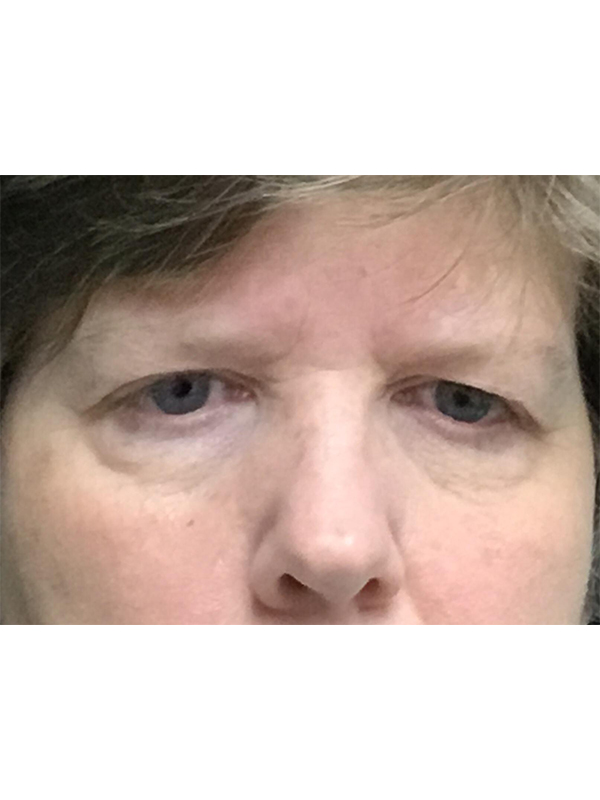 Brow Lift And Blepharoplasty Before and After | Montilla Plastic Surgery 