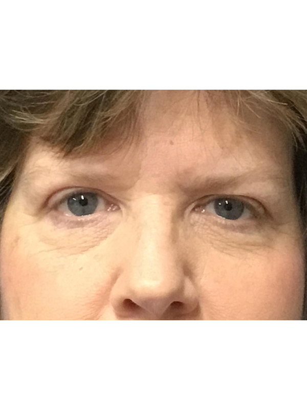 Brow Lift And Blepharoplasty Before and After | Montilla Plastic Surgery 