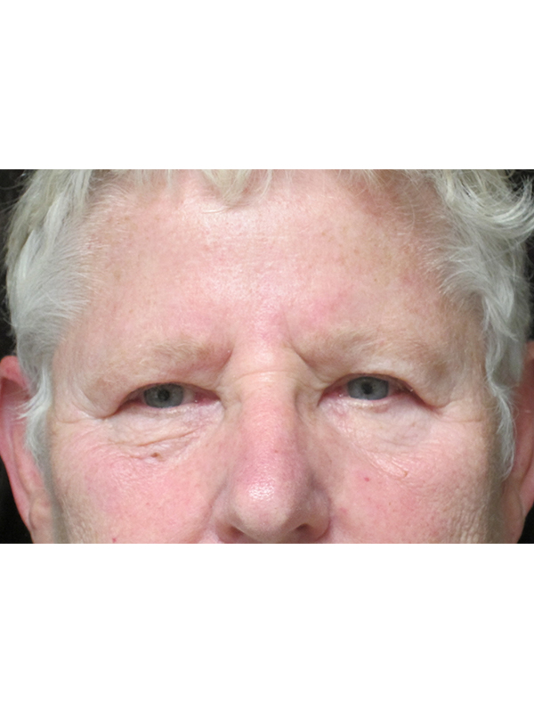 Brow Lift And Blepharoplasty Before and After | Montilla Plastic Surgery 