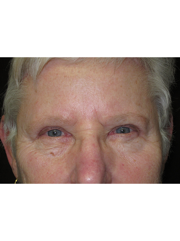 Brow Lift And Blepharoplasty Before and After | Montilla Plastic Surgery 