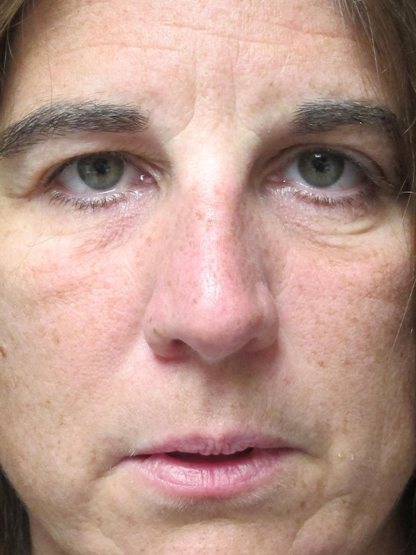 Brow Lift And Blepharoplasty Before and After | Montilla Plastic Surgery 