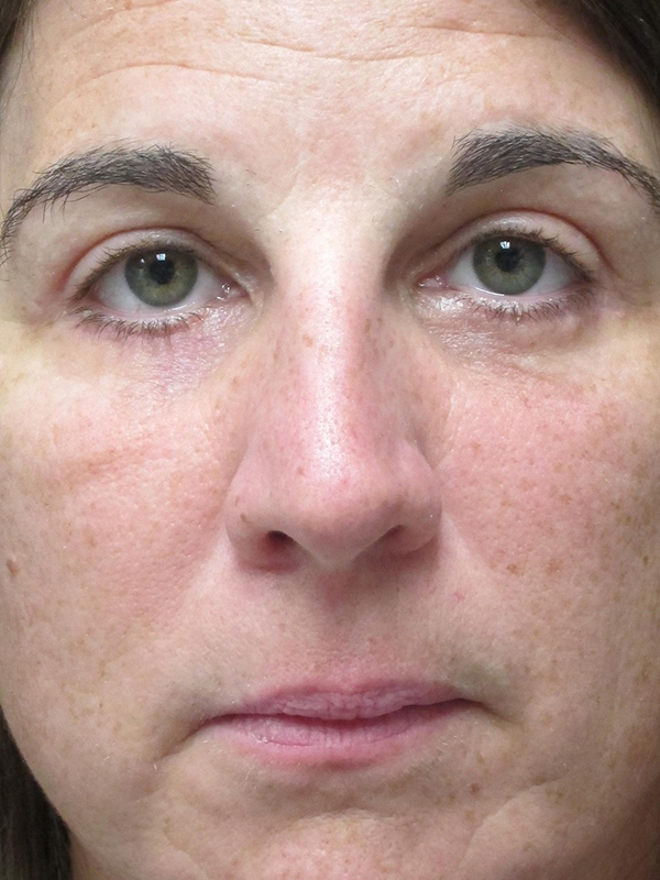 Brow Lift And Blepharoplasty Before and After | Montilla Plastic Surgery 