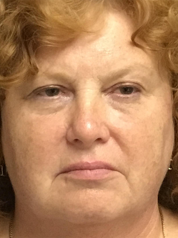 Brow Lift And Blepharoplasty Before and After | Montilla Plastic Surgery 
