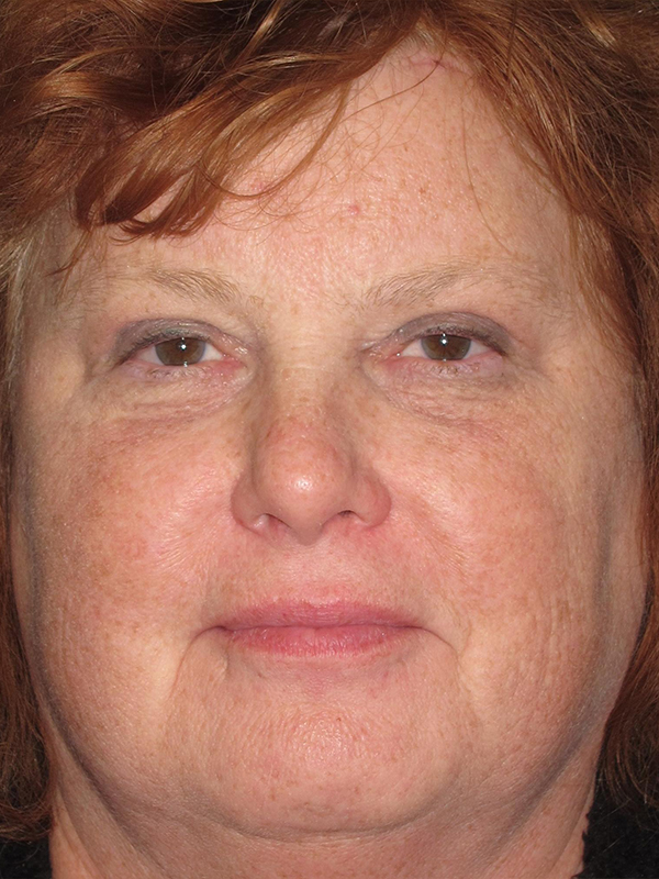 Brow Lift And Blepharoplasty Before and After | Montilla Plastic Surgery 