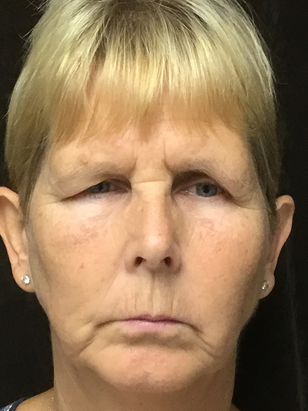 Brow Lift And Blepharoplasty Before and After | Montilla Plastic Surgery 