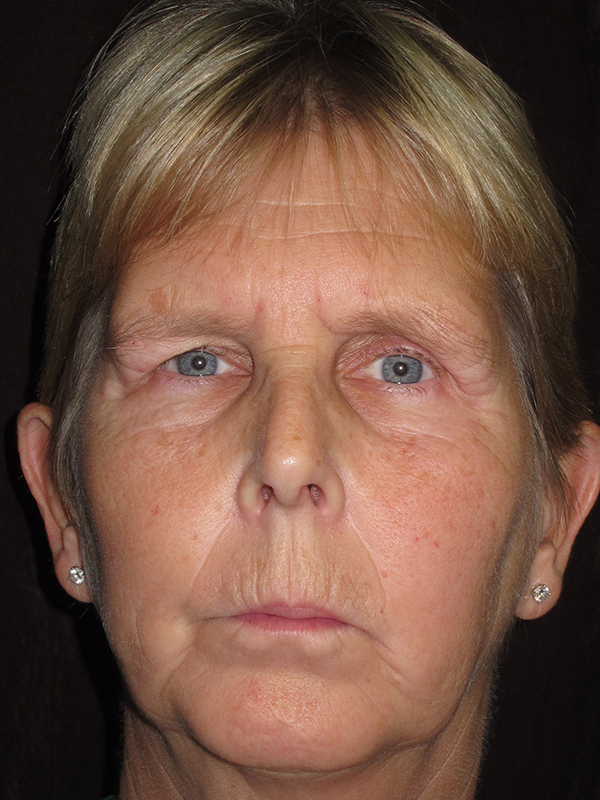 Brow Lift And Blepharoplasty Before and After | Montilla Plastic Surgery 