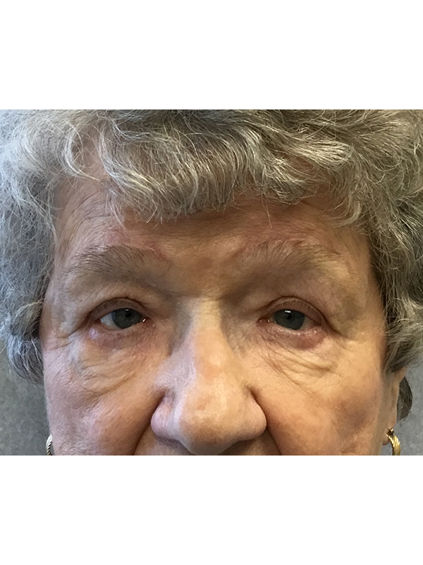 Brow Lift And Blepharoplasty Before and After | Montilla Plastic Surgery 