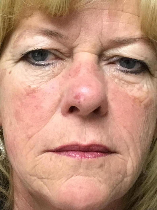 Brow Lift And Blepharoplasty Before and After | Montilla Plastic Surgery 