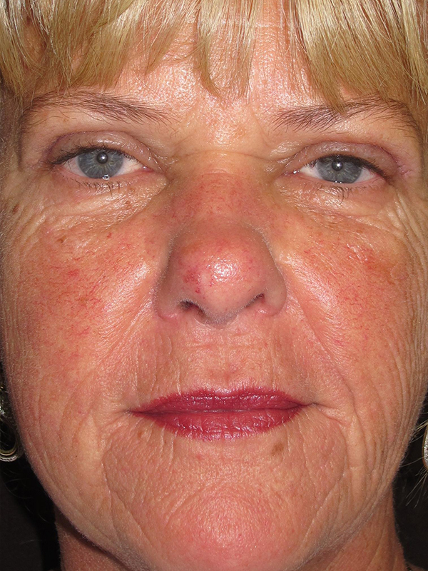 Brow Lift And Blepharoplasty Before and After | Montilla Plastic Surgery 
