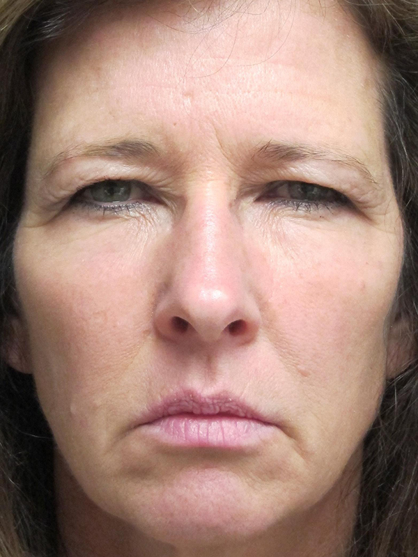 Brow Lift And Blepharoplasty Before and After | Montilla Plastic Surgery